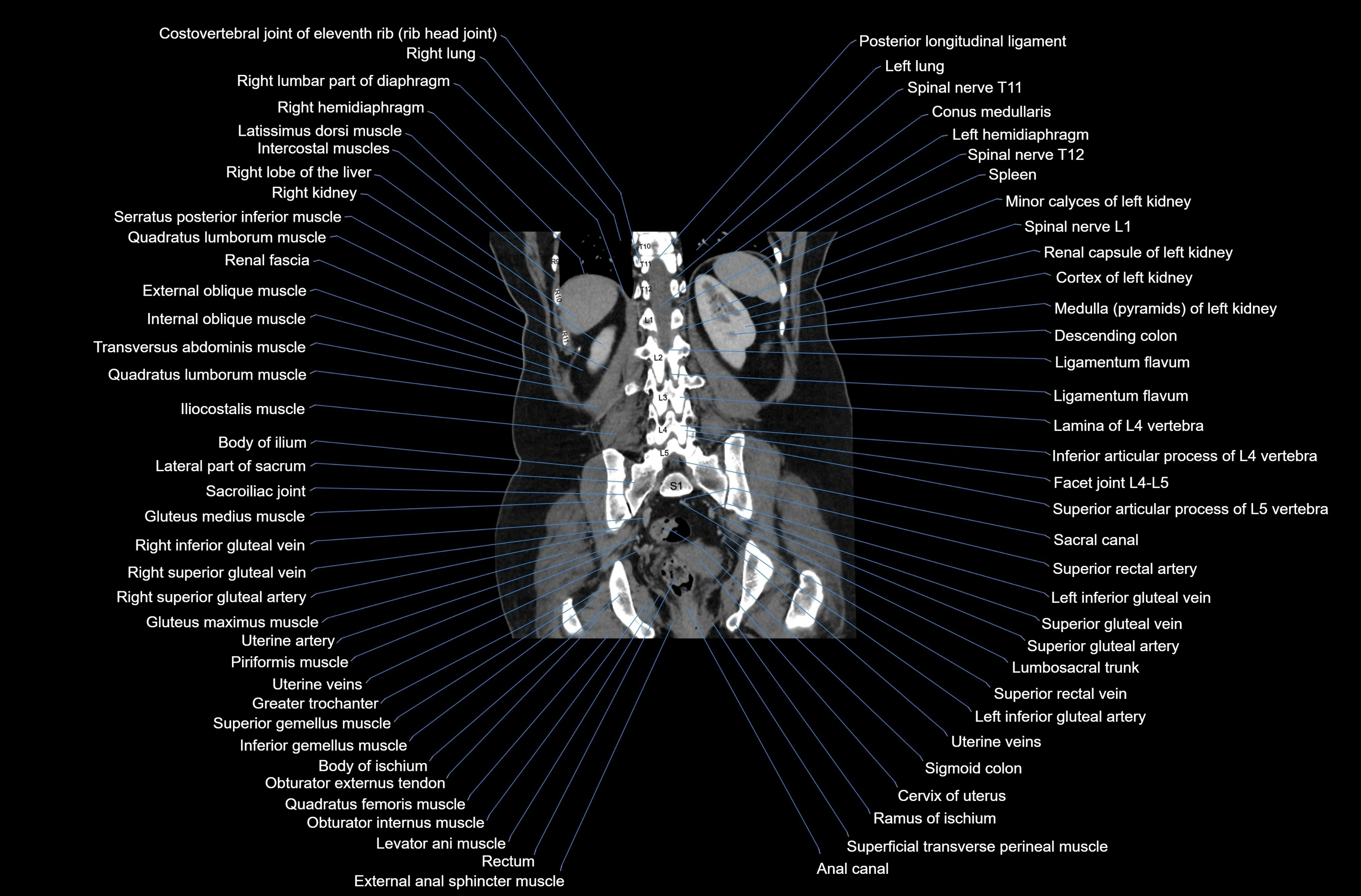 CT abdomen coronal cross sectional anatomy labelled radiology image-00064.webp